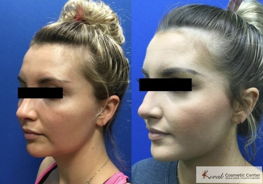 VLR - Vaser Laser - Jawline Sculpting - Case 1562