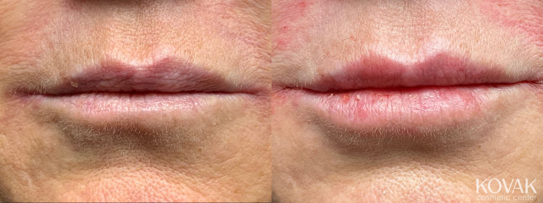 Before and after Lips - Plump / Filled case 36715