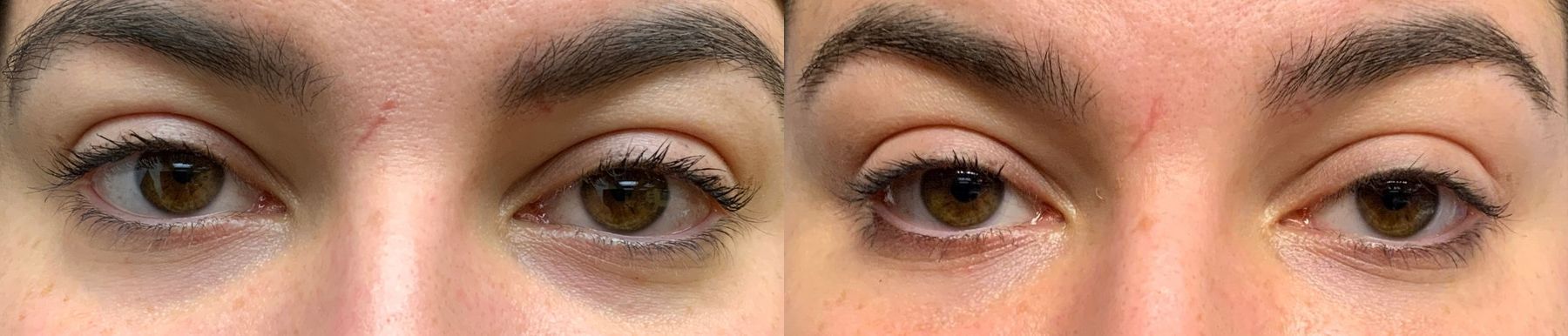 Before and after Eye Treatments case 36698