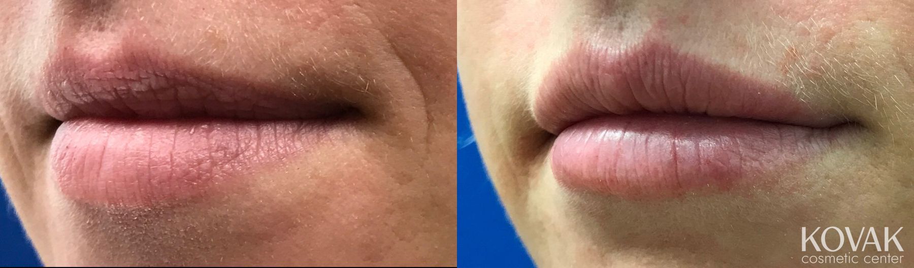 Before and after Lip Augmentation case 36603