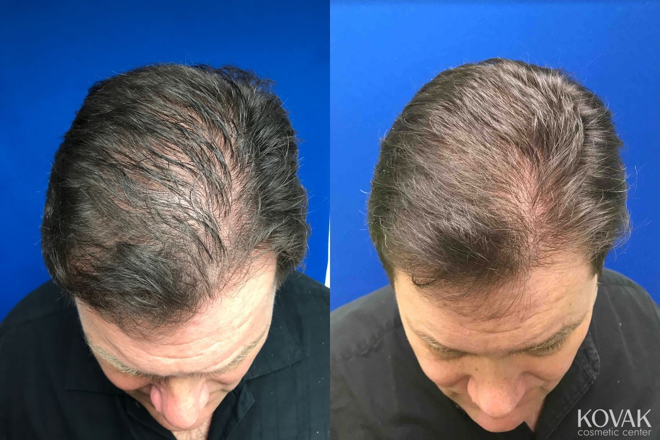 Before and after Hair Transplantation case 36635