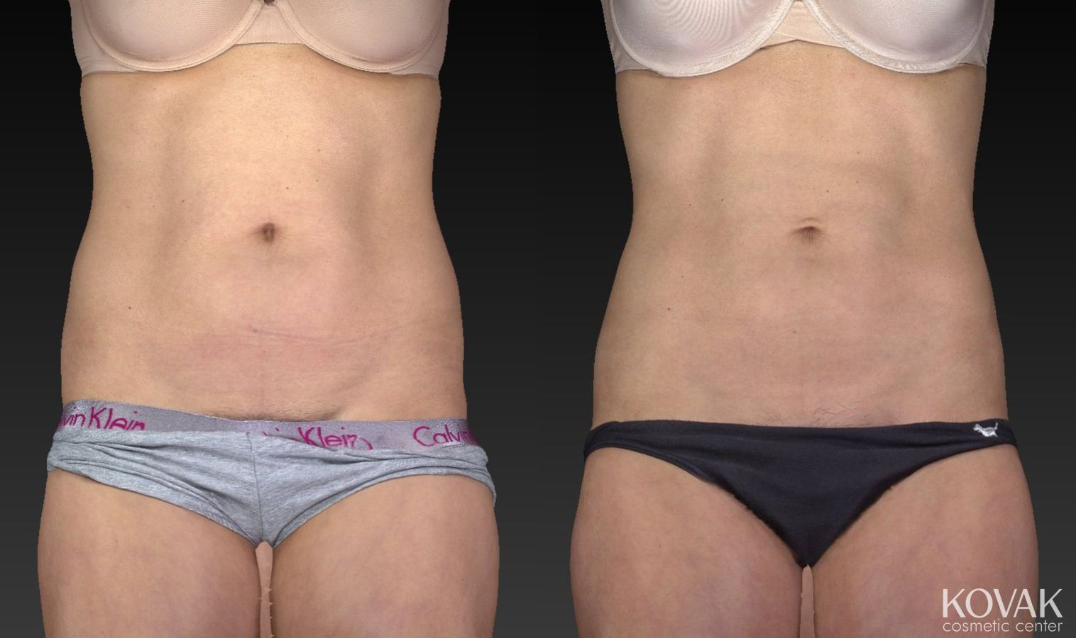 Before and after CoolSculpting® case 36580