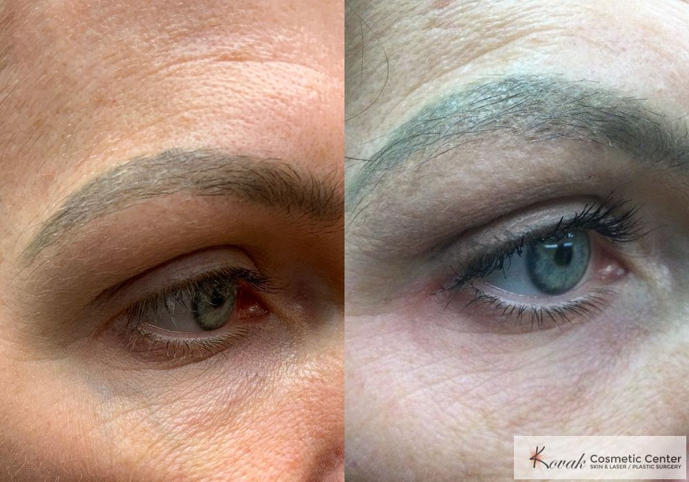 Eye Vein Treatment - Case 1498