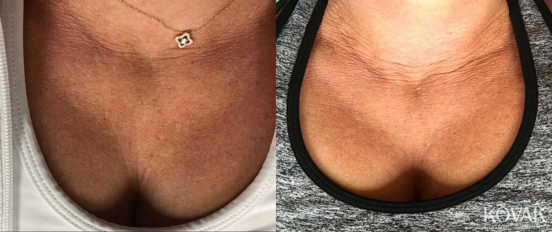 Before and after Restylane® Silk case 36556