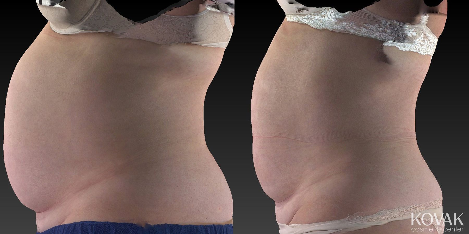 Before and after CoolSculpting® case 36481 - Angle 3