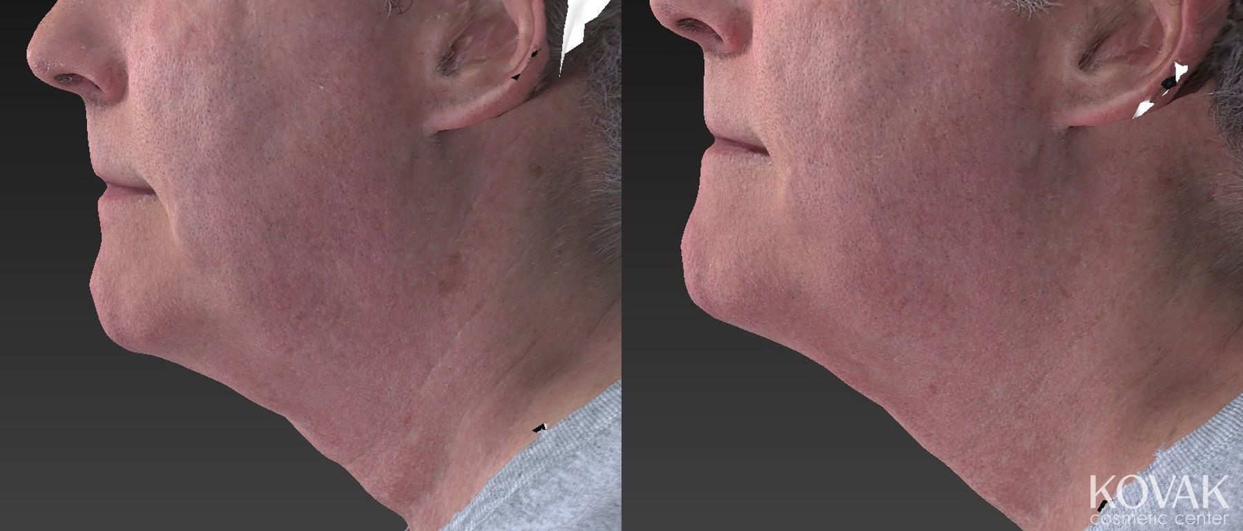 Before and after Kybella case 36640 - Angle 2