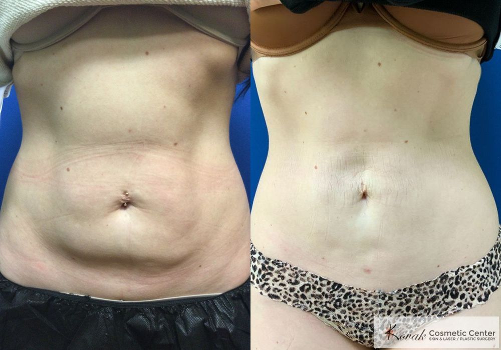 Emsculpt Neo - Case 1460