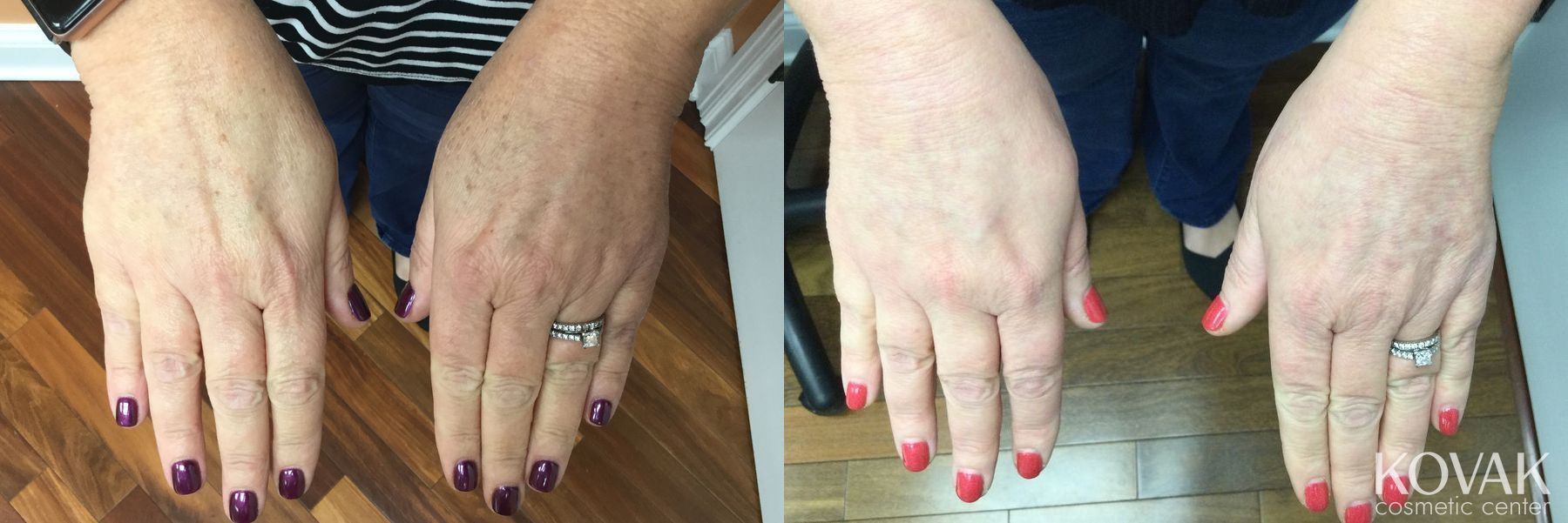 Before and after Tyte and Bryte Photorejuvenation case 36736