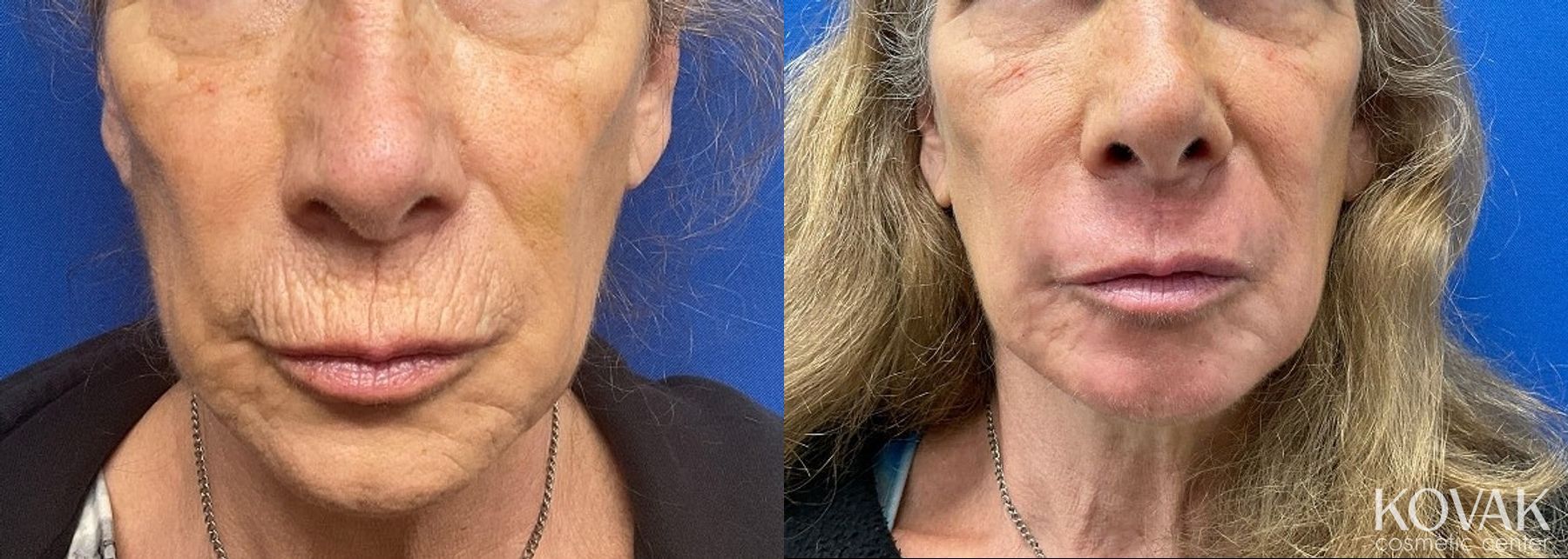 Before and after Laser Skin Resurfacing - Face case 36732