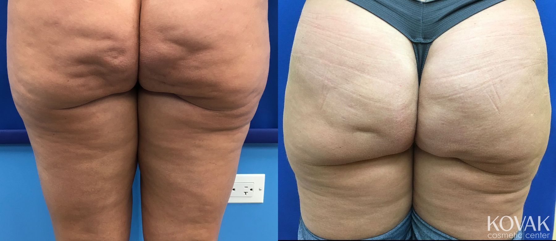 Before and after Cellulite Reduction case 36665