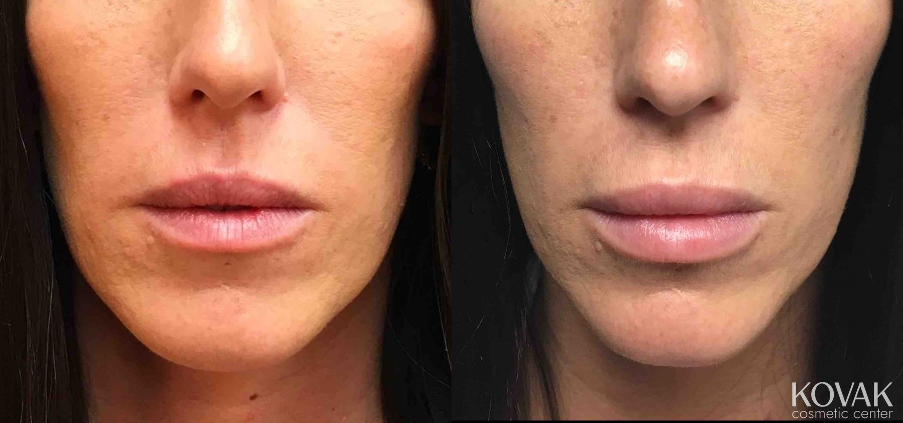 Before and after Injectables case 36659
