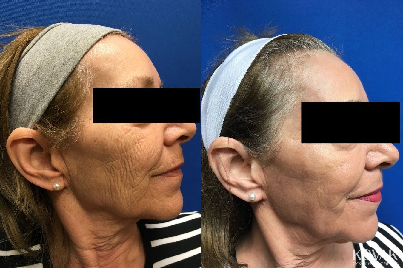 Before and after Laser Skin Resurfacing - Face case 36624 - Angle 3