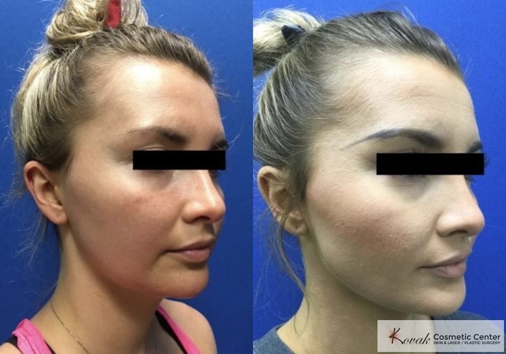 VLR - Vaser Laser - Jawline Sculpting - Thumbnail 2