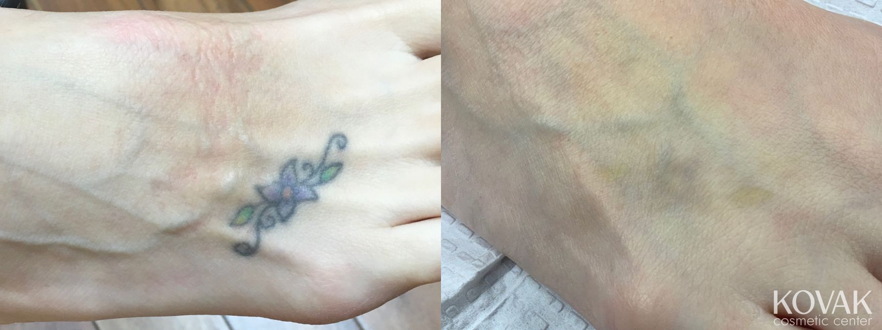 Before and after Tattoo Removal case 36702