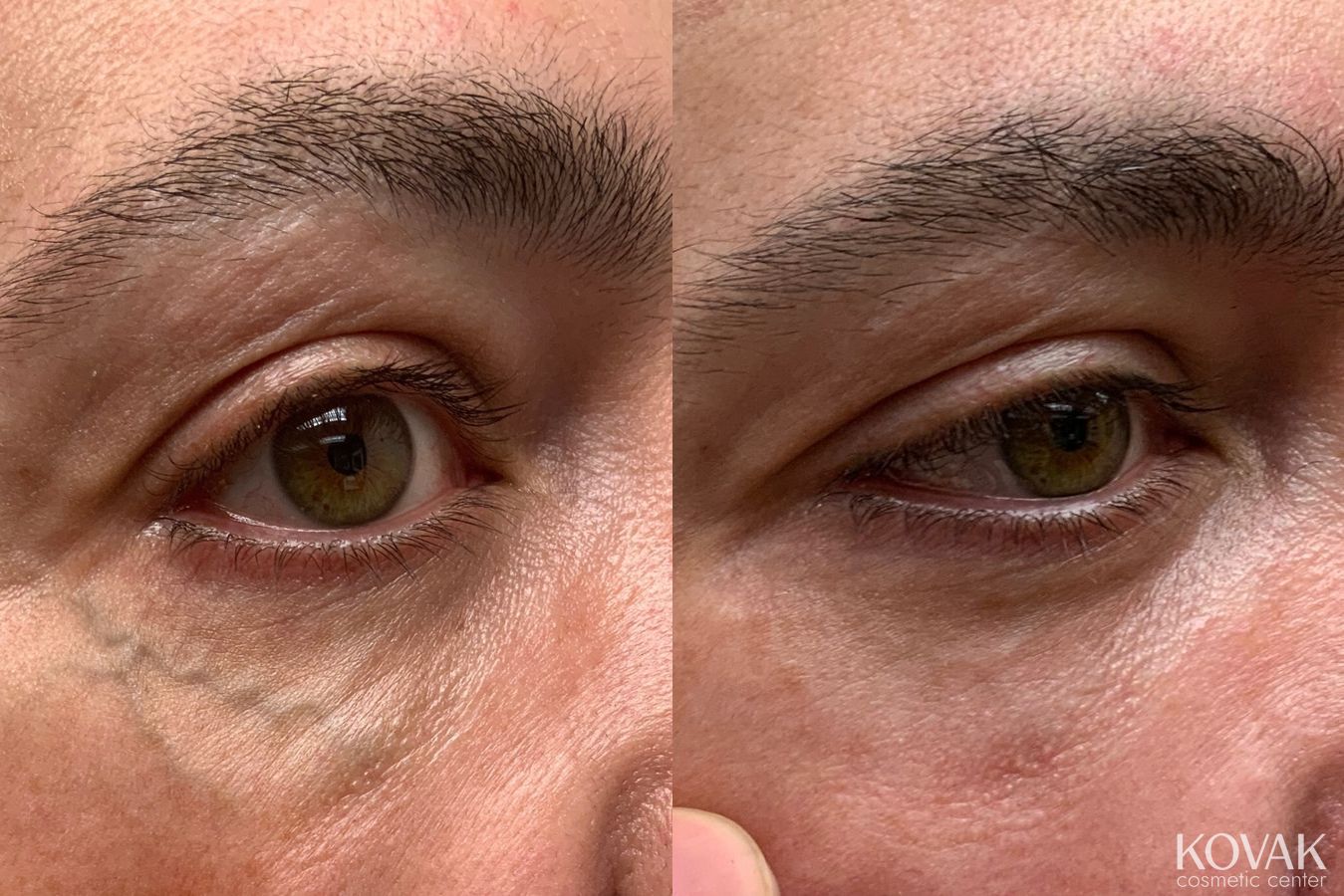 Before and after Eye Vein Treatment case 36744 - Angle 2