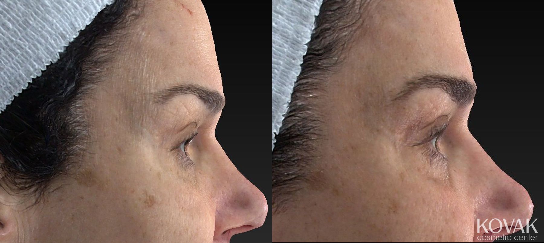Before and after Laser Skin Resurfacing - Face case 36594