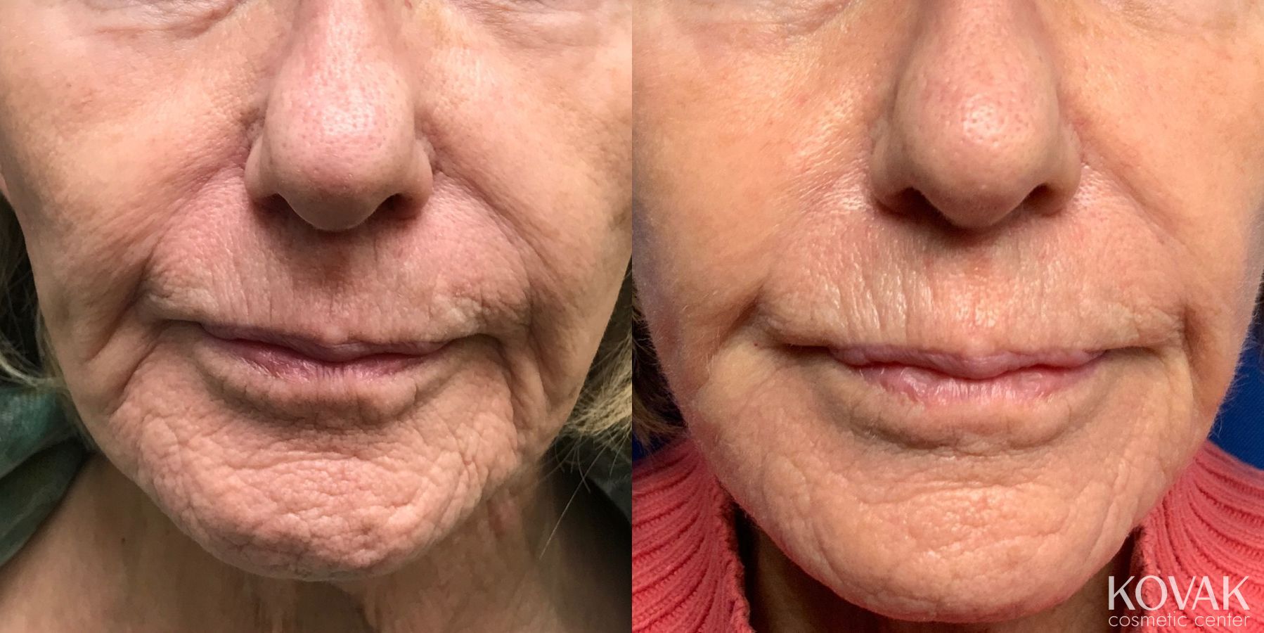 Before and after Laser Skin Resurfacing - Face case 36718
