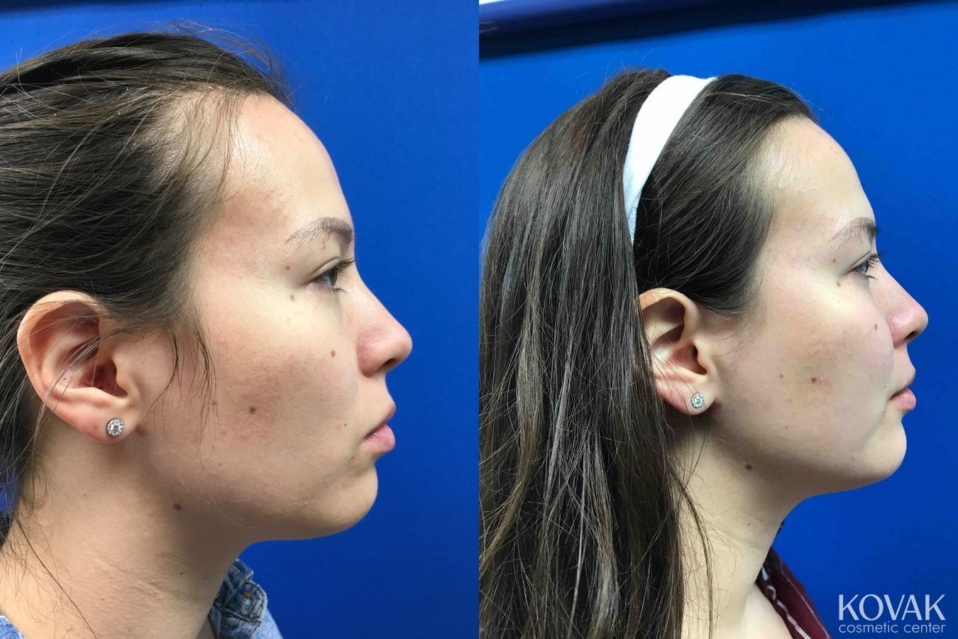 Before and after Restylane® Lyft case 36625 - Angle 3