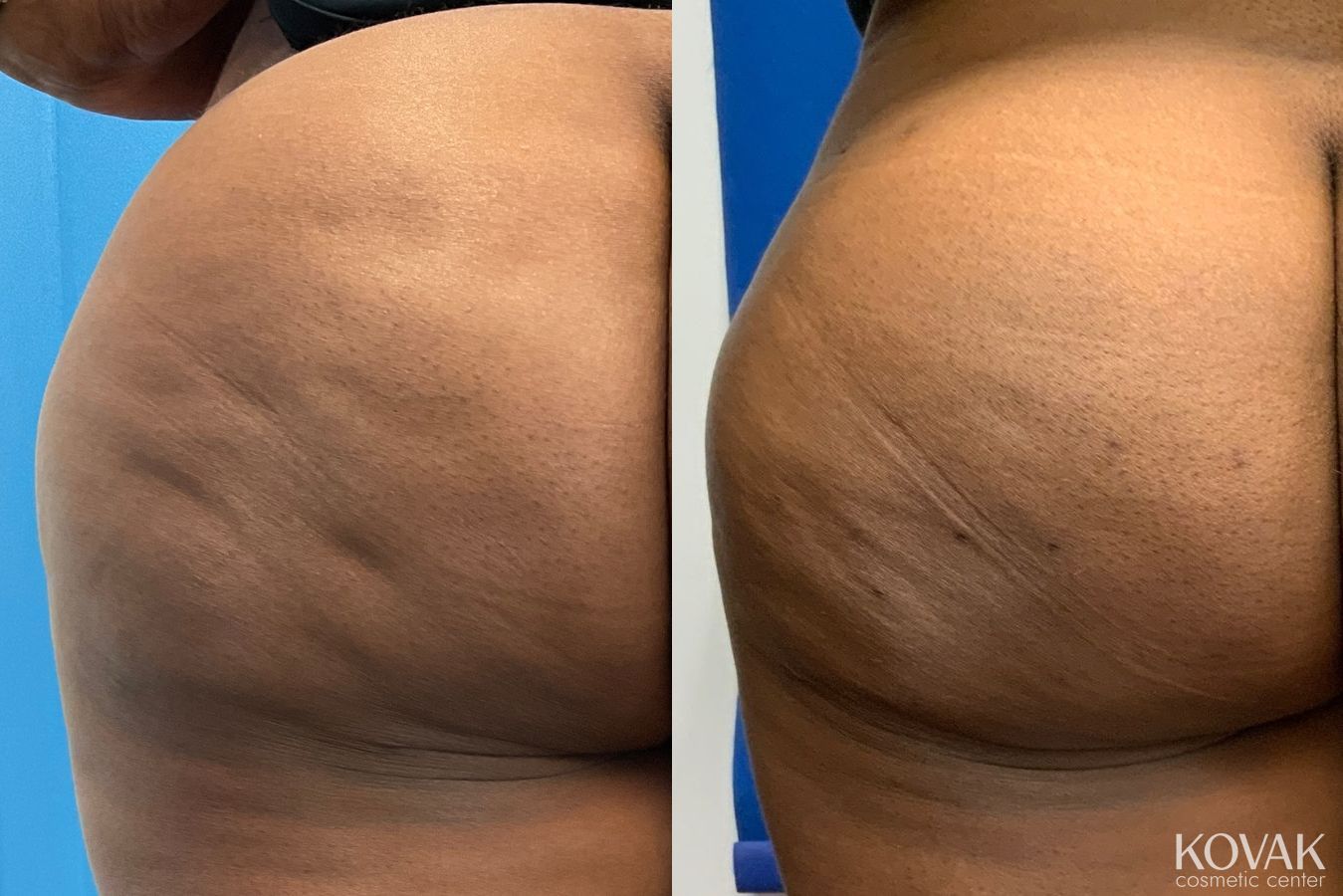 Before and after Cellulite Reduction case 36701