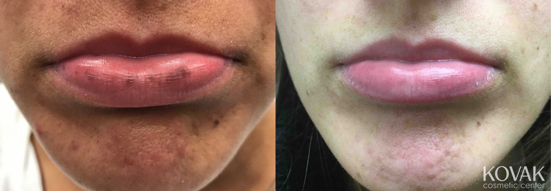 Before and after Lents case 36610