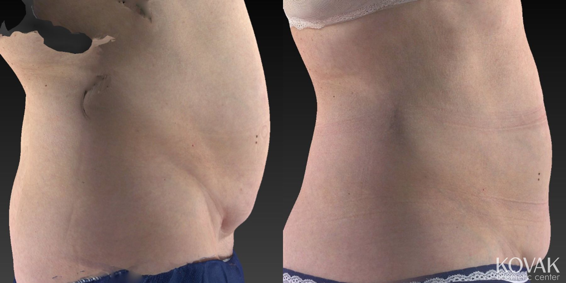 Before and after CoolSculpting® case 36564