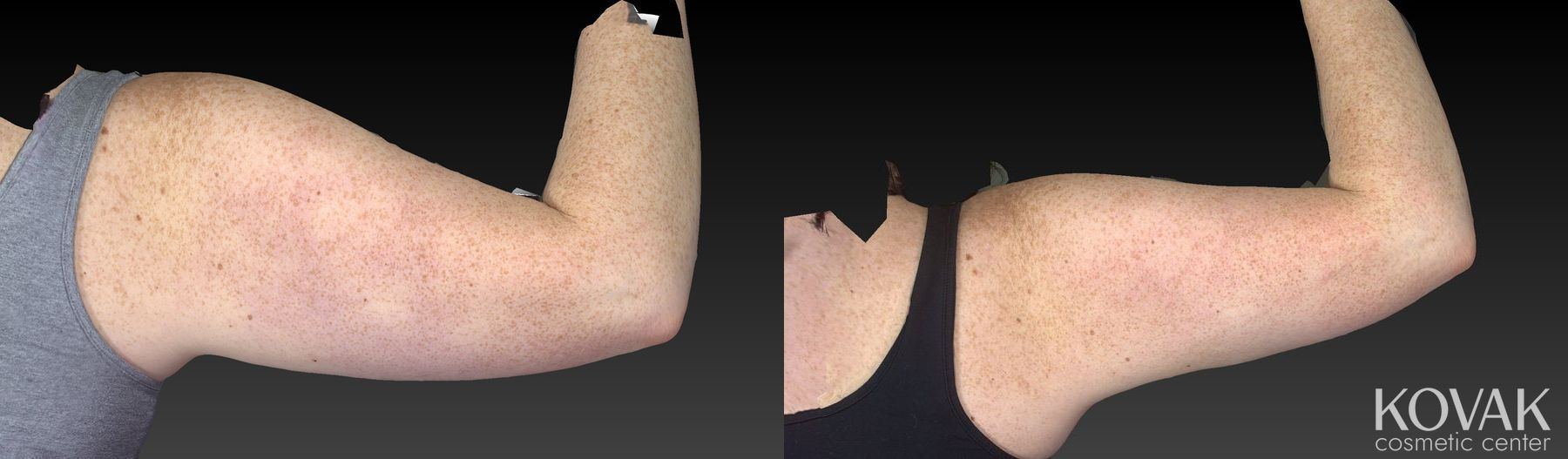Before and after CoolSculpting® case 36593 - Angle 2