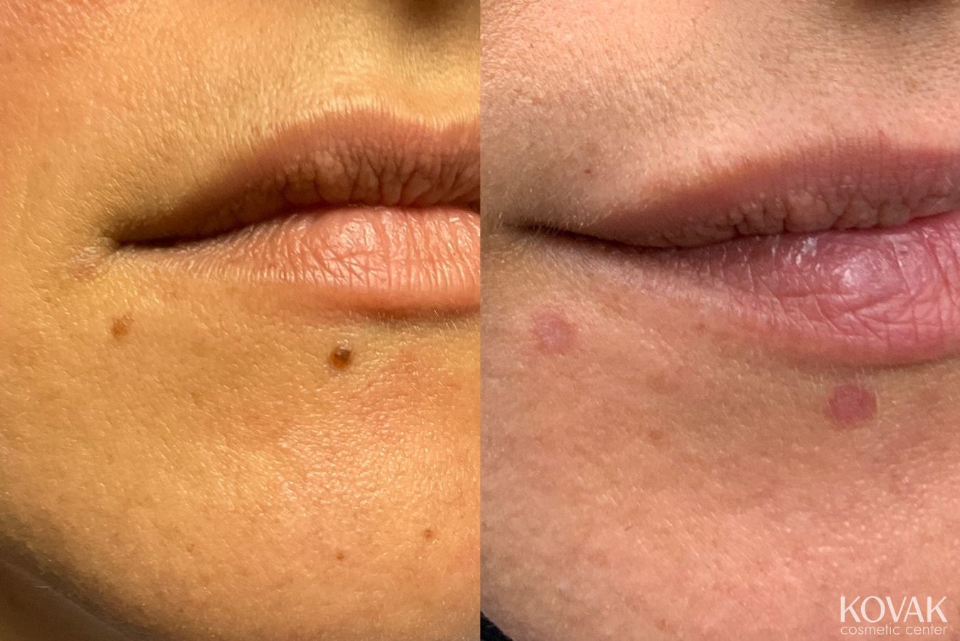Before and after Mole Removal case 36692