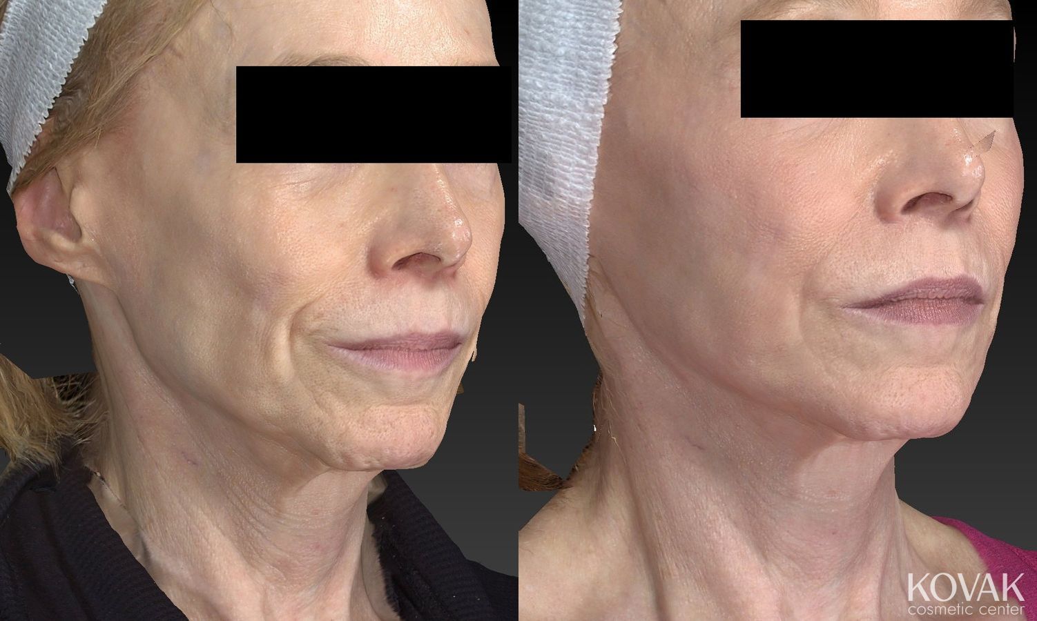 Before and after Sculptra® case 36464 - Angle 3