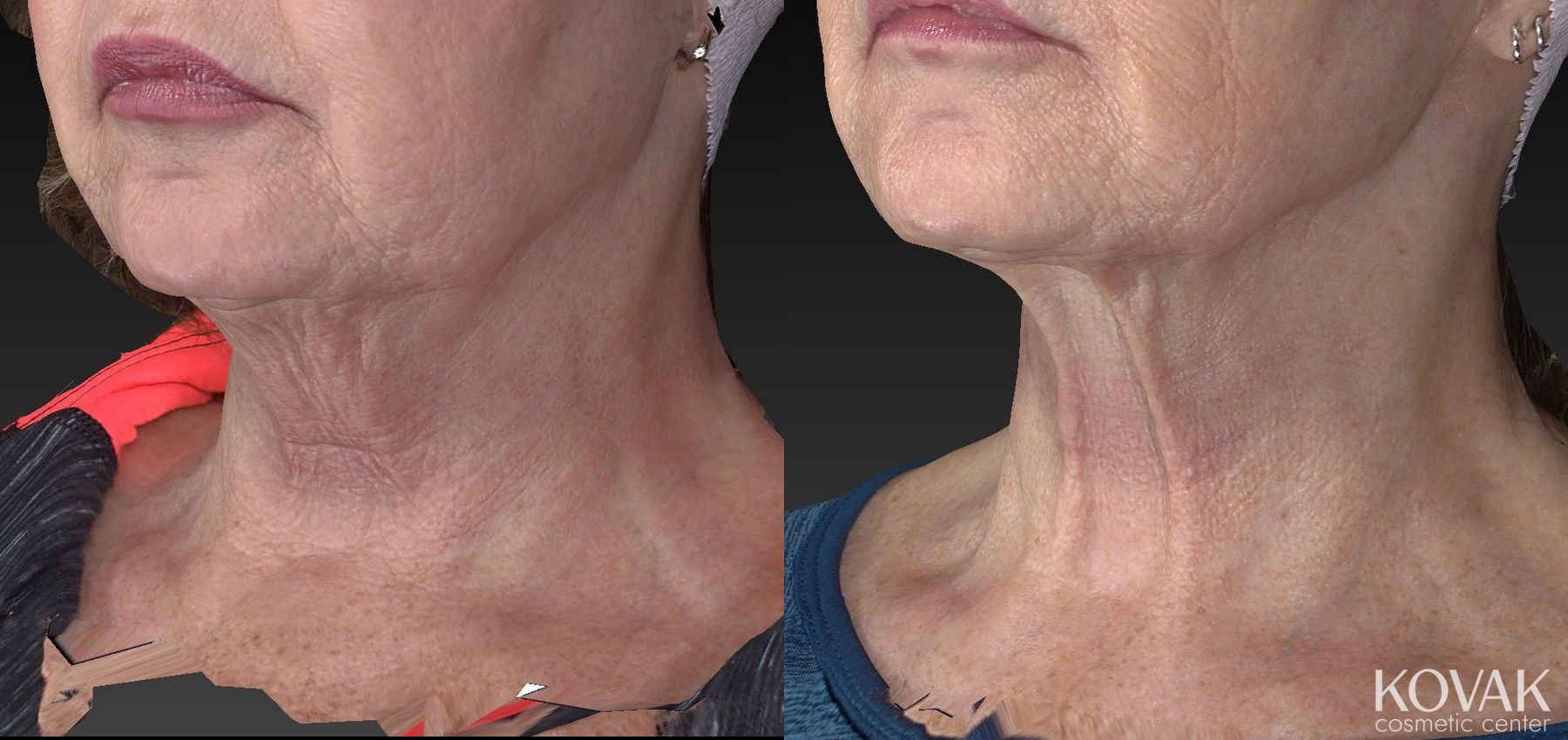 Before and after Kybella case 36483 - Angle 3