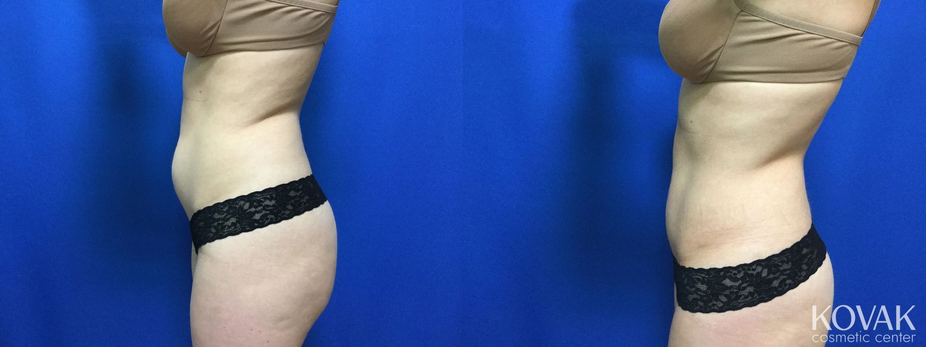 Before and after CoolSculpting® case 36543 - Angle 2