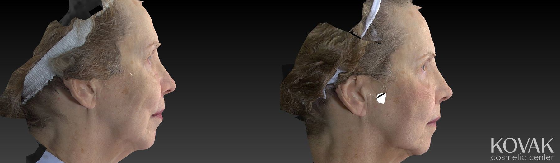 Before and after Sculptra® case 36561 - Angle 2