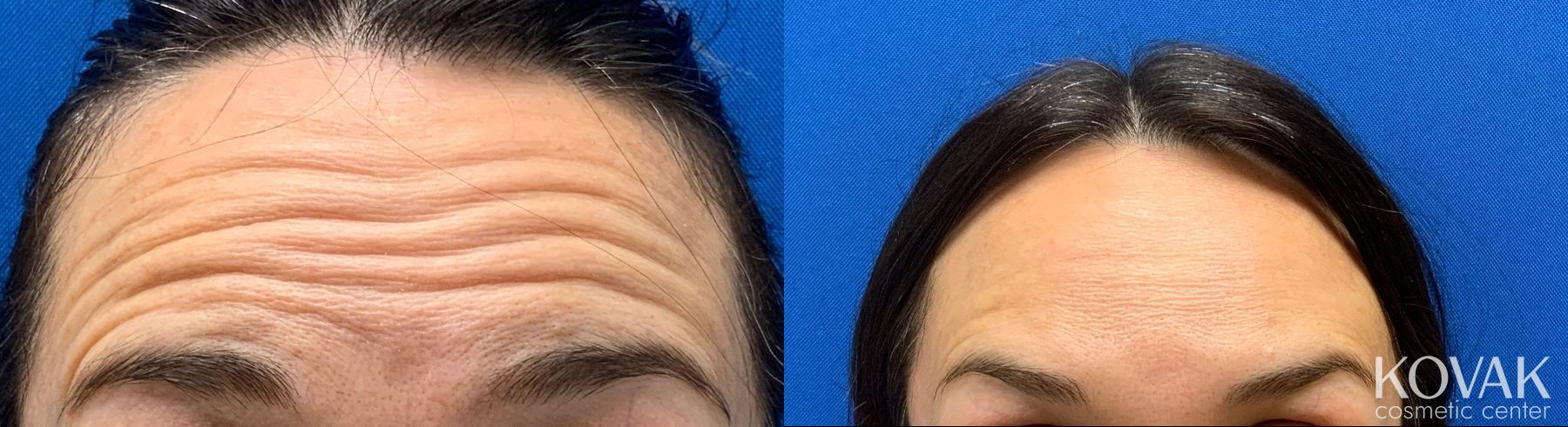 Before and after Neurotoxin (Botox, Jeuveau, Dysport & Xeomin) case 36704