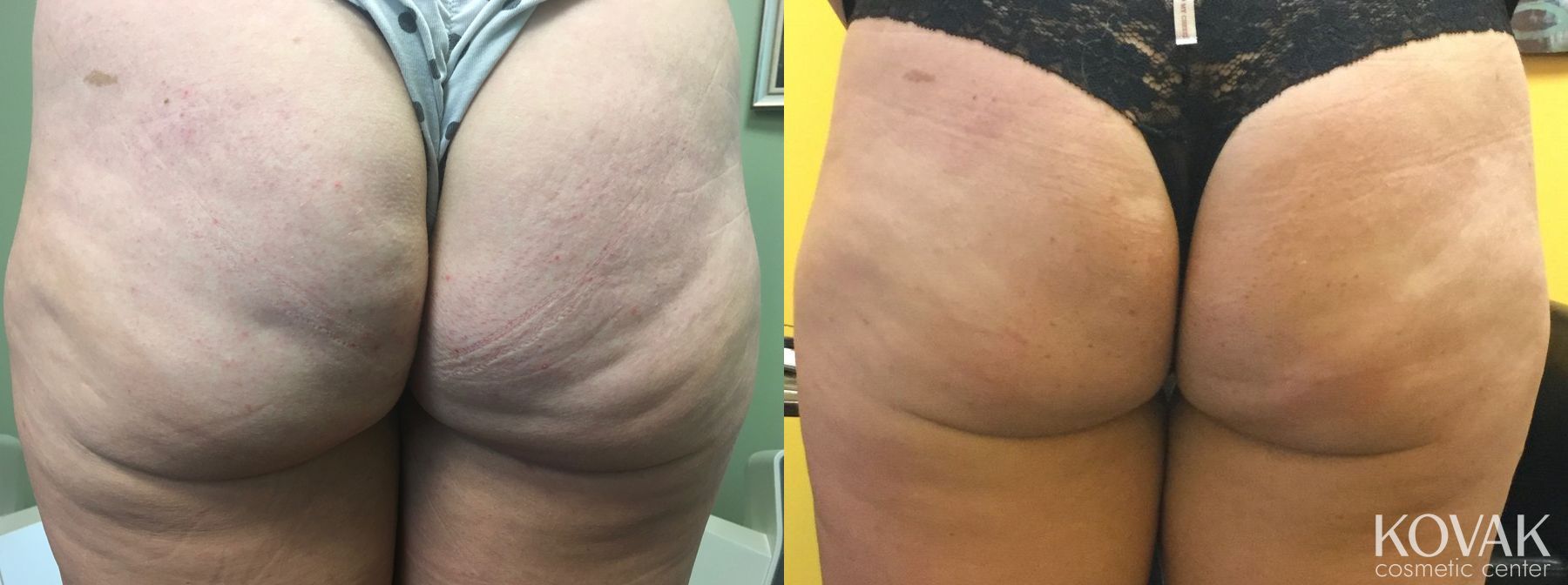 Before and after Cellulite Reduction case 36526