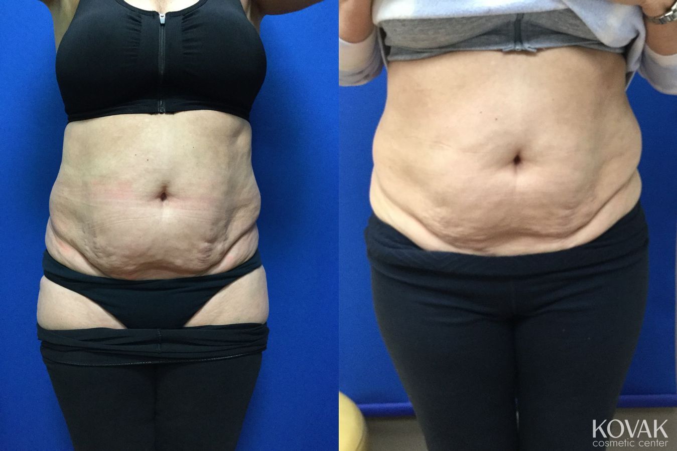 Before and after Emsculpt Neo case 36723