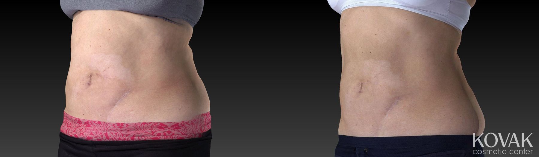 Before and after CoolSculpting® case 36542 - Angle 3