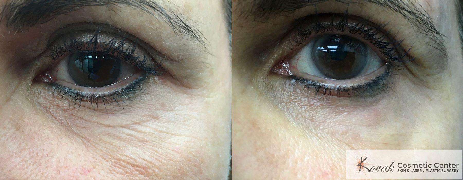 Eye Treatments - Thumbnail 2