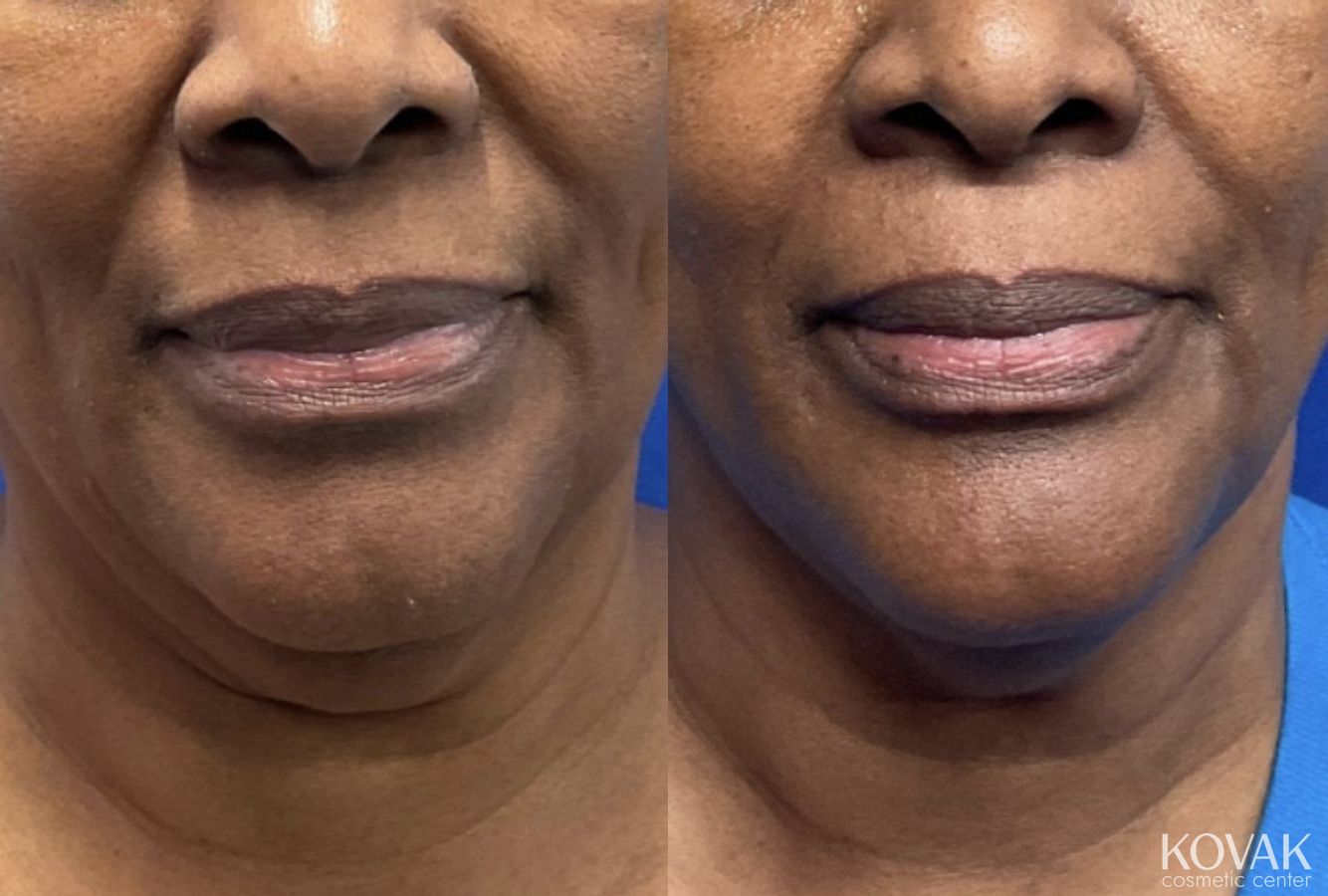 Before and after VLR - Vaser Laser - Jawline Sculpting case 36765 - Angle 2