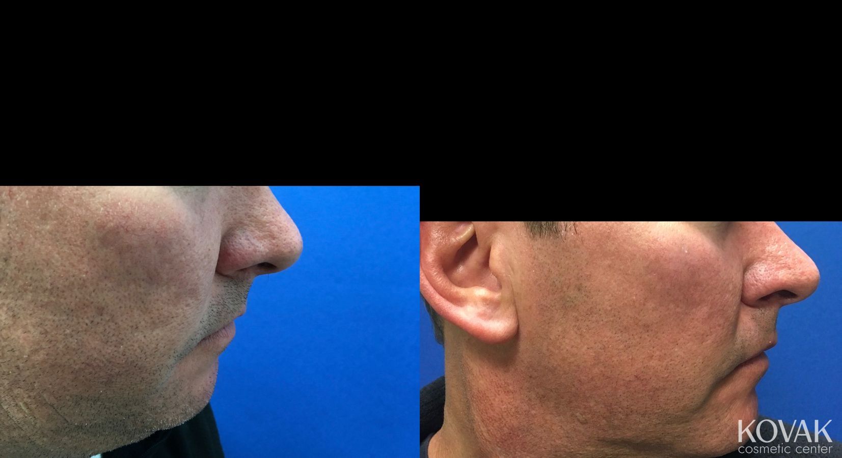 Before and after Juvéderm® XC case 36463 - Angle 3
