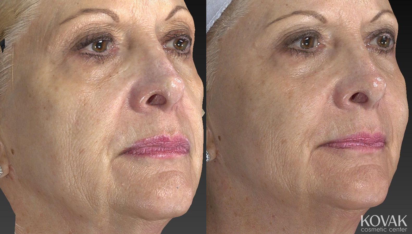 Before and after Injectables - Face case 36537 - Angle 3