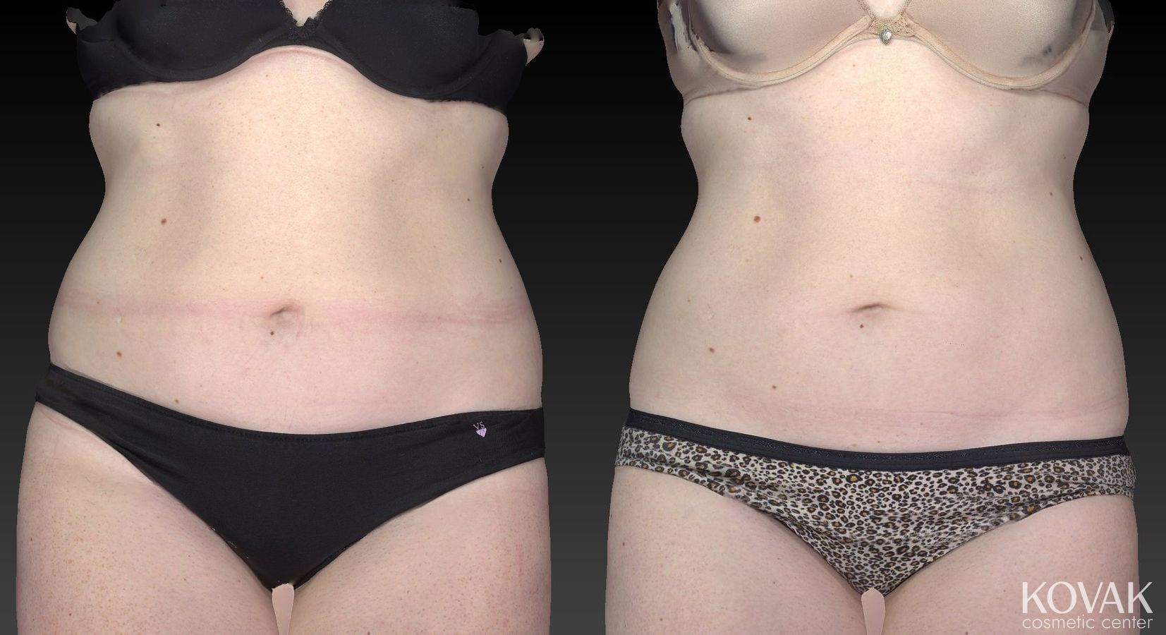 Before and after CoolSculpting® case 36604 - Angle 5