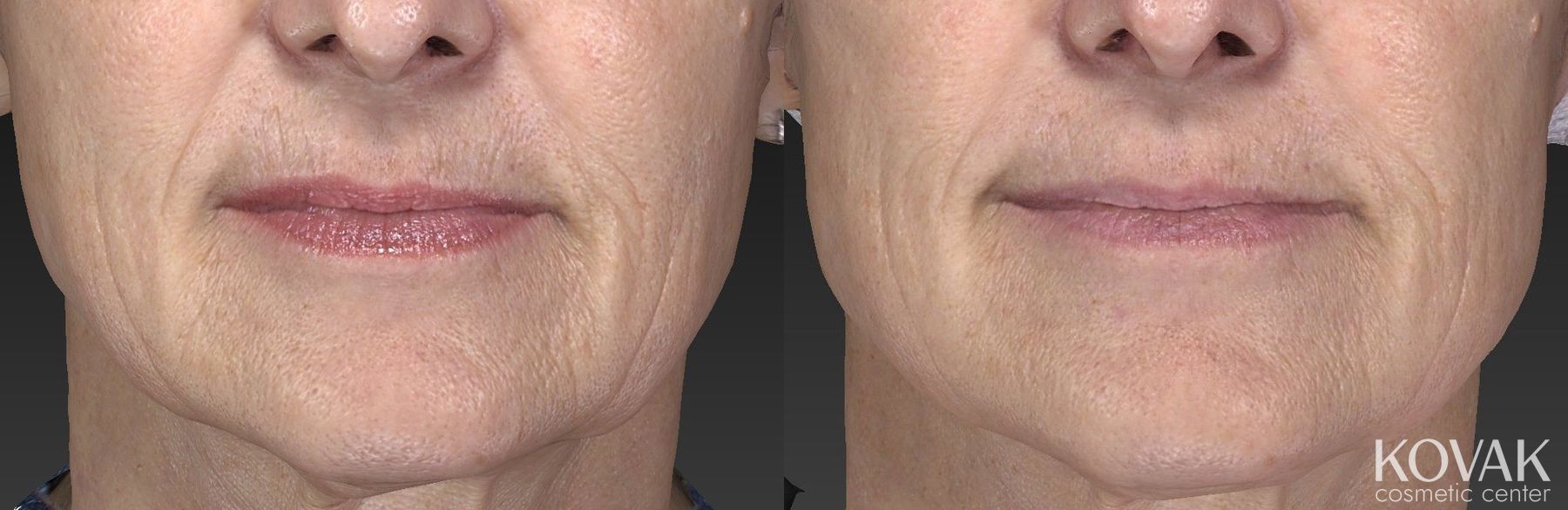 Before and after Restylane® Silk case 36462