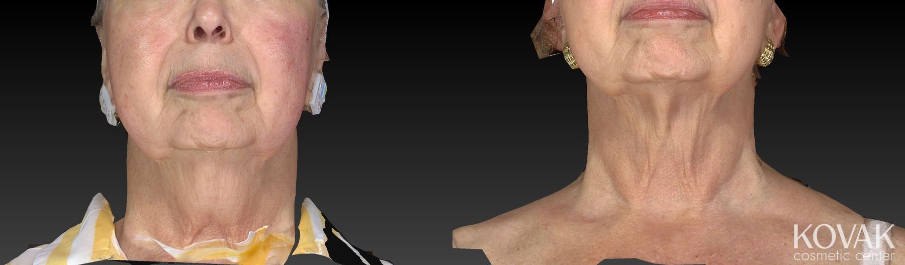 Before and after Kybella case 36525 - Angle 3