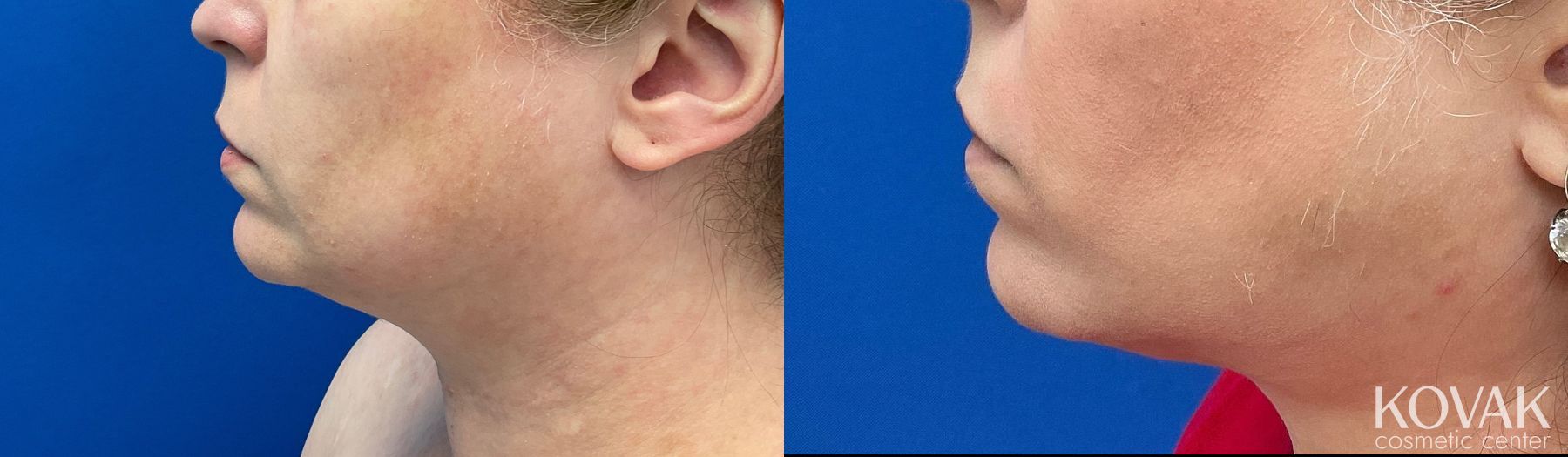 Before and after Laser Liposuction case 36709