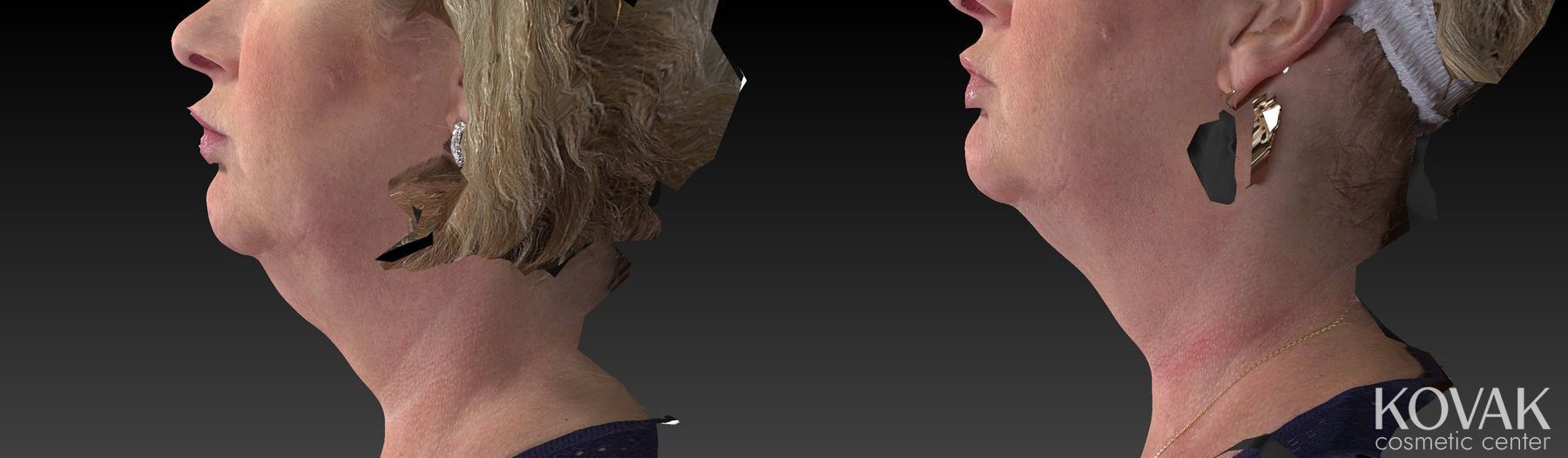 Before and after Kybella case 36478 - Angle 4