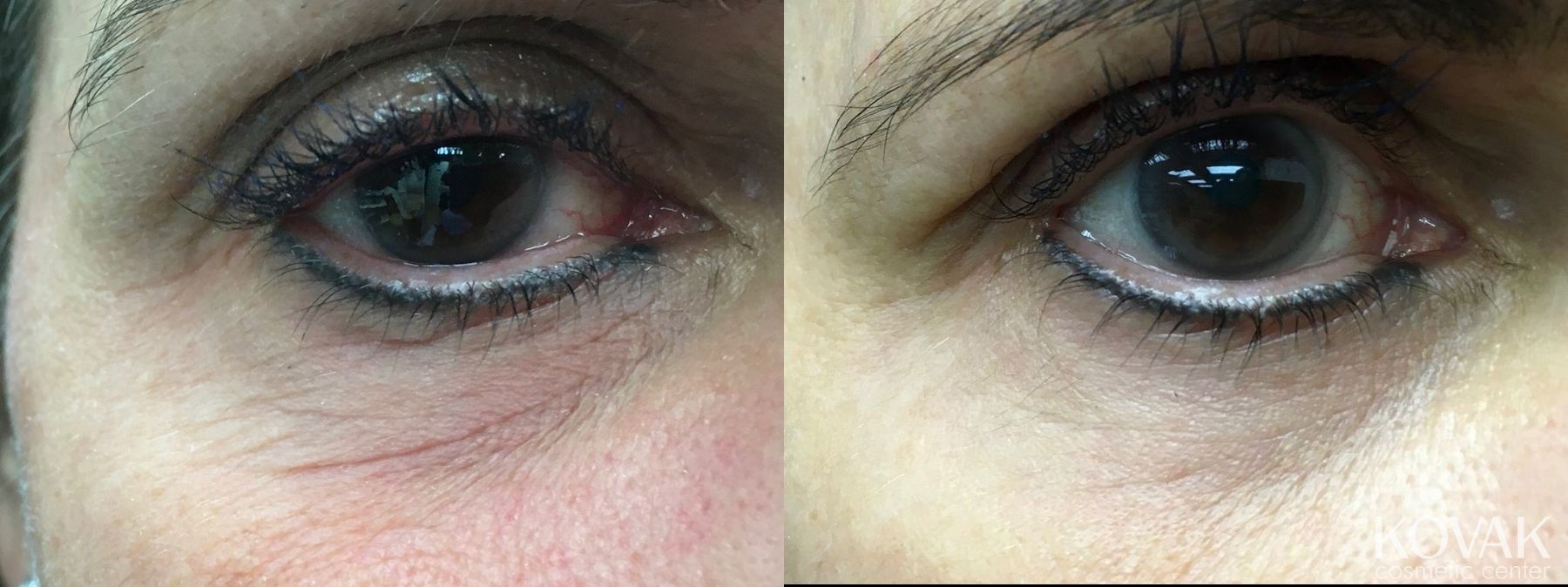 Before and after Eye Treatments case 36595