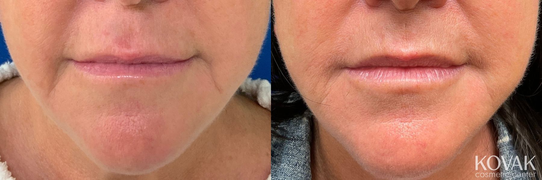 Before and after Fillers case 36741