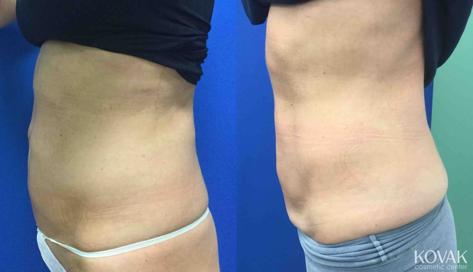 Before and after EMSCULPTĀ® case 36684 - Angle 2