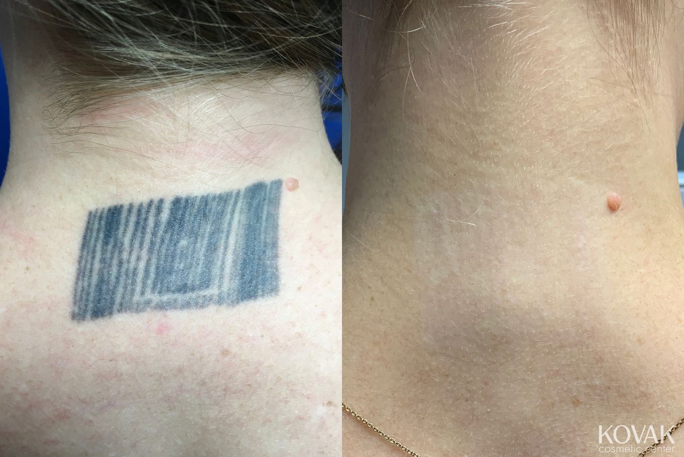 Before and after Tattoo Removal case 36737