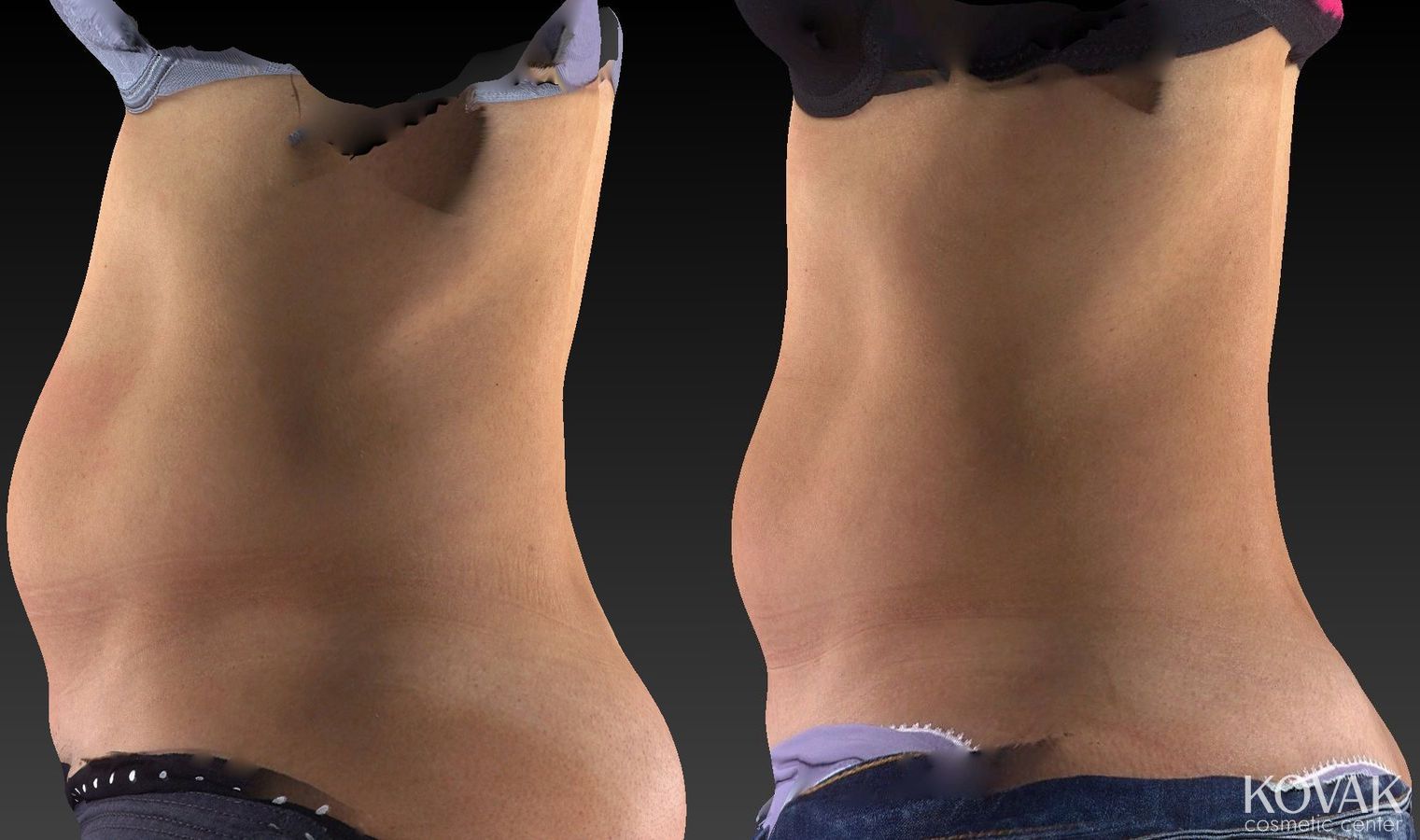 Before and after CoolSculpting® case 36479 - Angle 3