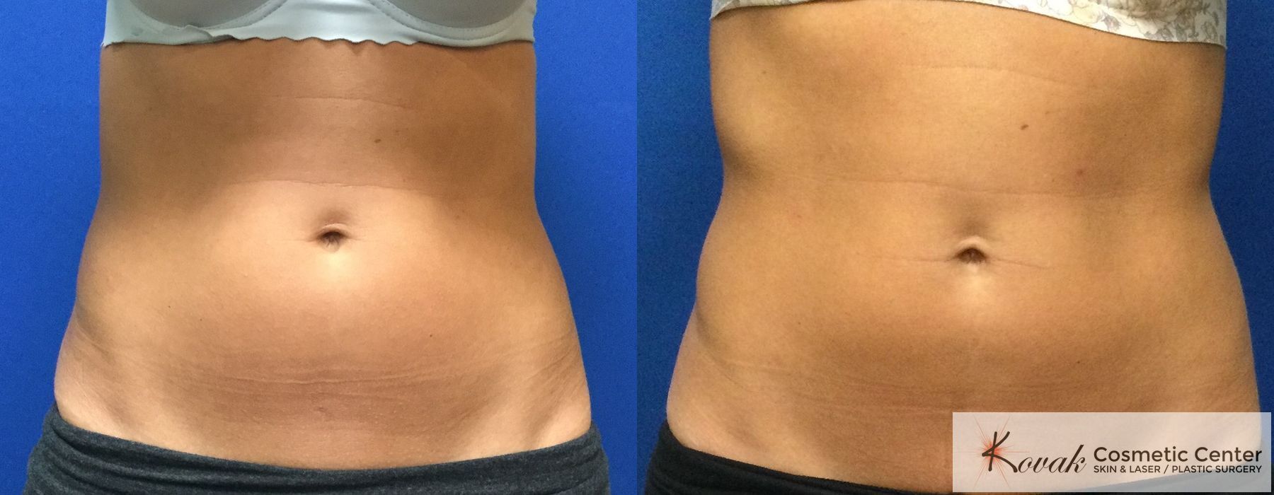 CoolSculpting® - Case 1589
